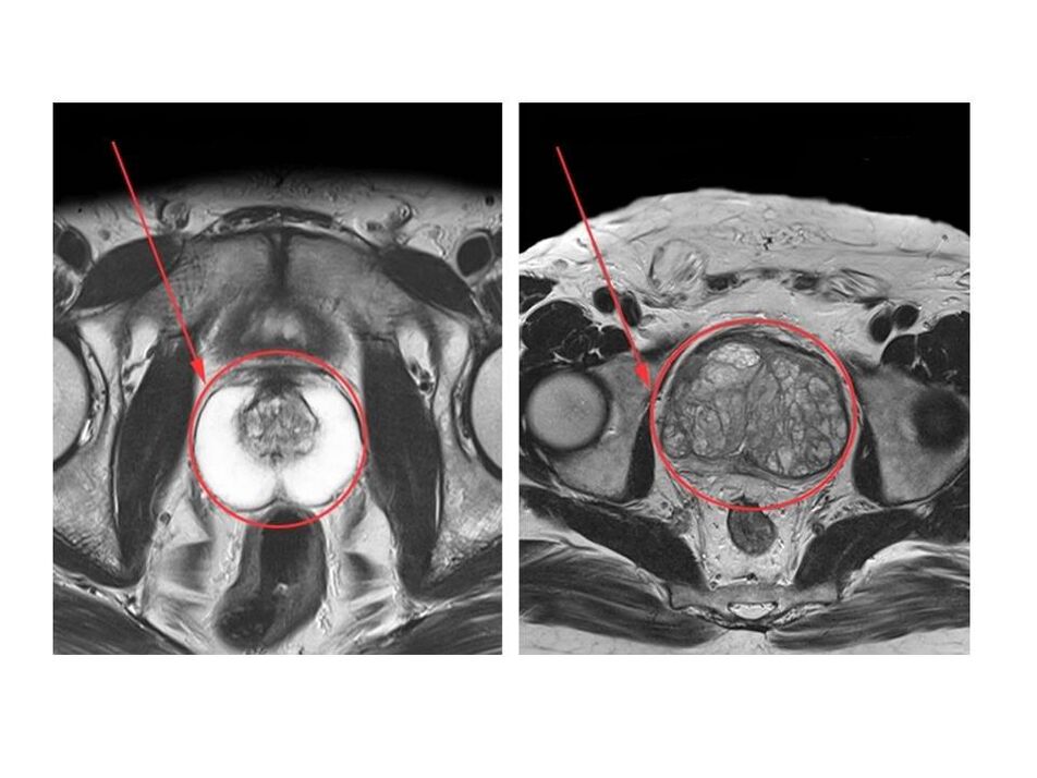 MRI сүрөттөрүндө дени сак (солдо) жана сезгенген (оңдо) простата безин салыштыруу