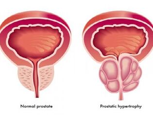Нормалдуу жана сезгенген простата